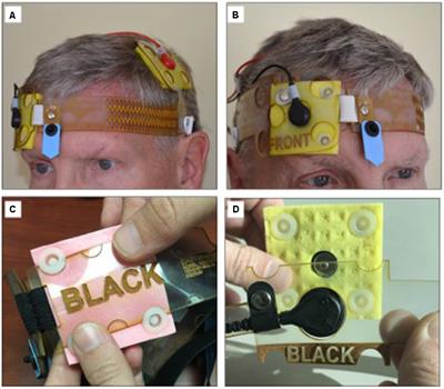 At-Home Transcranial Direct Current Stimulation (tDCS) With Telehealth Support for Symptom Control in Chronically-Ill Patients With Multiple Symptoms